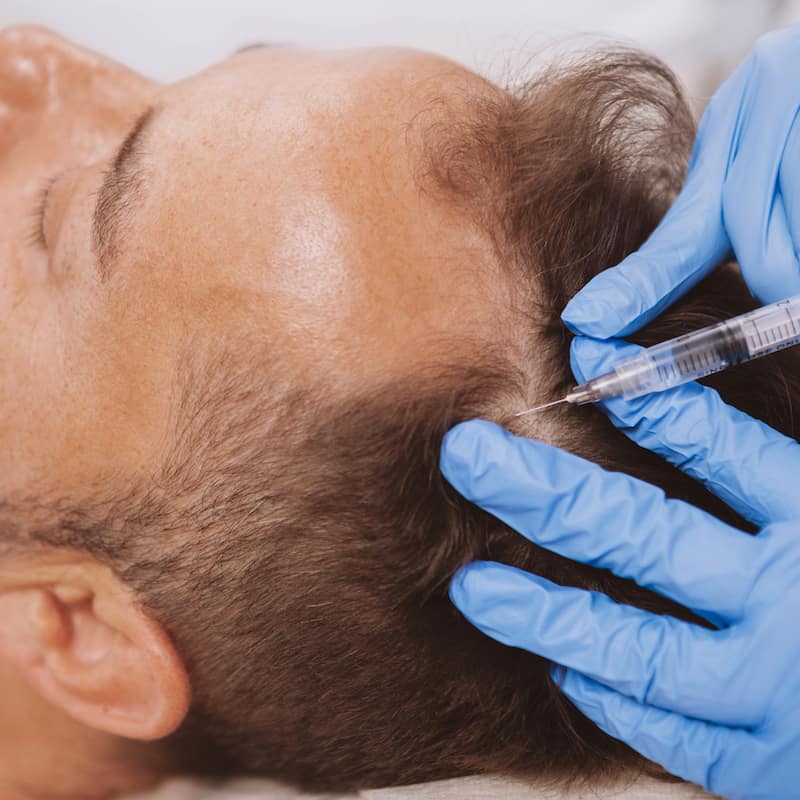 Close up of a mature man receiving hairloss treatment injections in scalp by professional trichologist. Dermatologist doing scalp injections for mature male client with alopecia problem